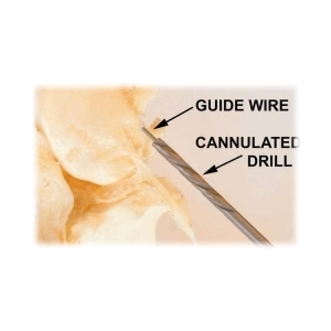 Punta Da Trapano Chirurgica Stryker XFO082501 – Standard 2,5mm X L110mm Per Ortopedia E Medicina D'urgenza